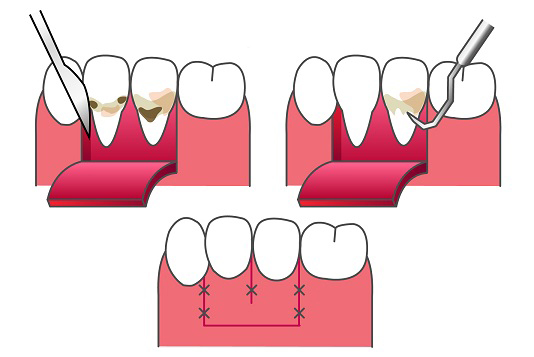 国立の歯医者、国立深澤歯科クリニックの歯周病治療