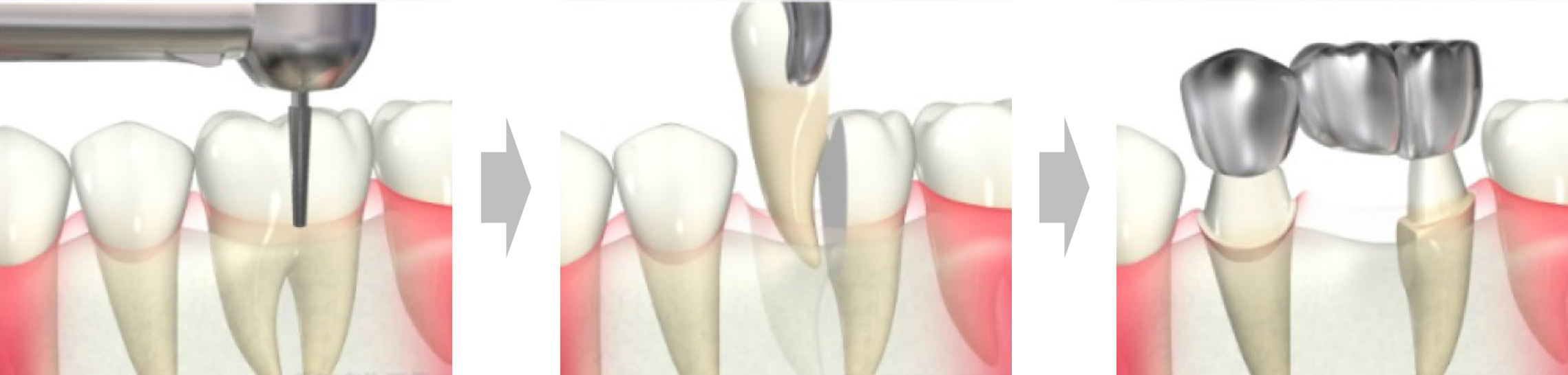 国立の歯医者、国立深澤歯科クリニックのの精密根管治療