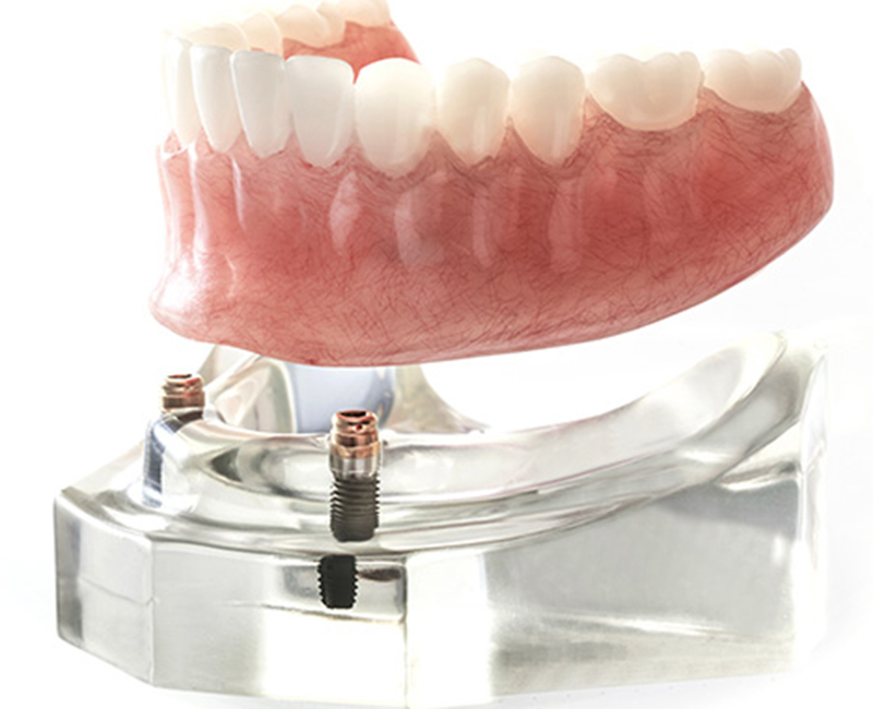 国立の歯医者、国立深澤歯科クリニックの入れ歯治療