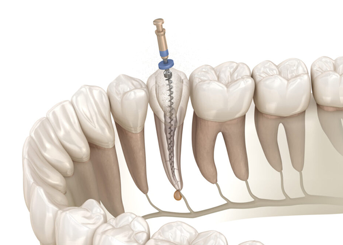 国立の歯医者、国立深澤歯科クリニックの根管治療