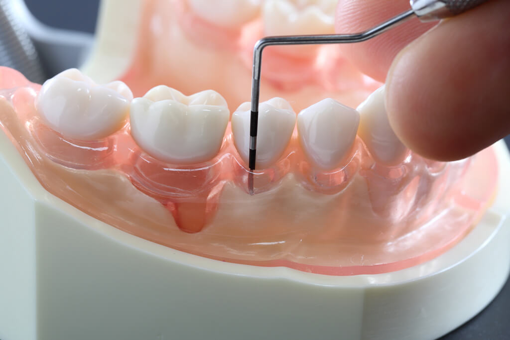 国立の歯医者、国立深澤歯科クリニックの歯周病検査