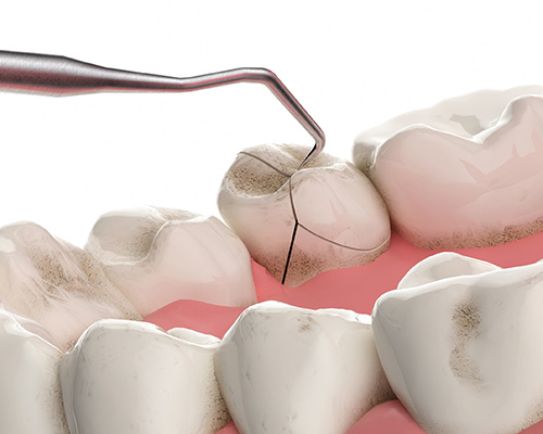 国立の歯医者、国立深澤歯科クリニックのマイクロスコープ精密治療