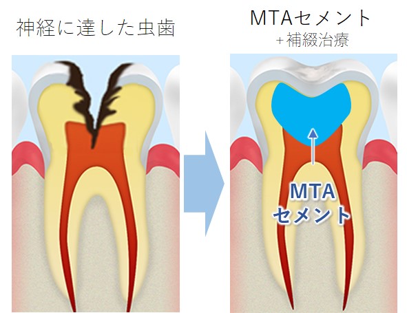 国立の歯医者、国立深澤歯科クリニックのMTAセメント