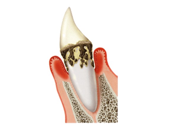 国立の歯医者、国立深澤歯科クリニックの歯周病治療