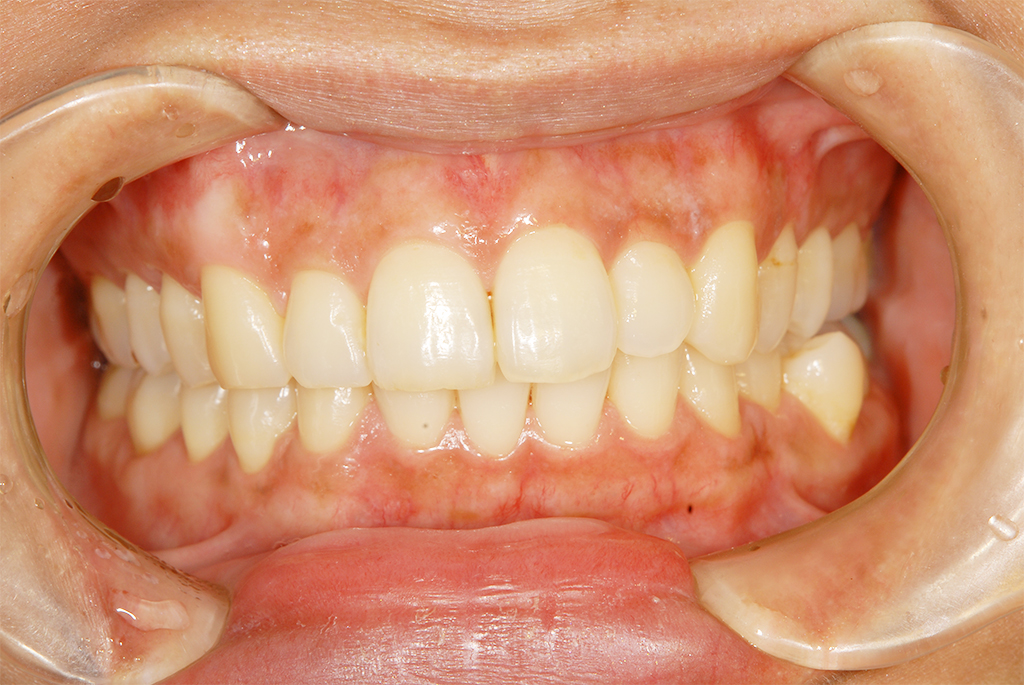 国立の歯医者、国立深澤歯科クリニックのガムピーリング治療例
