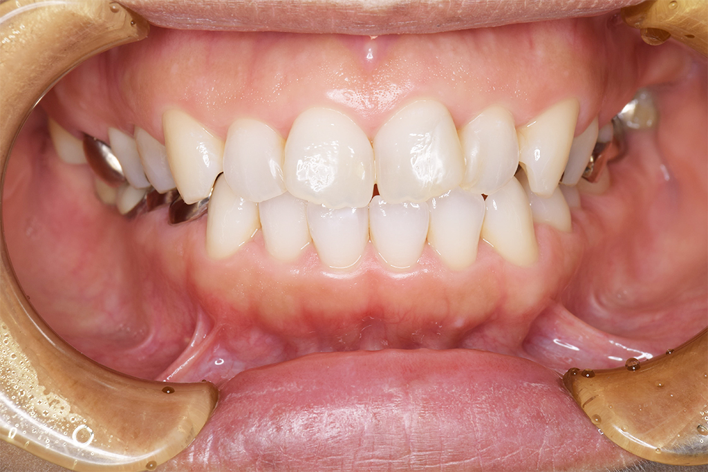 国立の歯医者、国立深澤歯科クリニックのホワイトニング