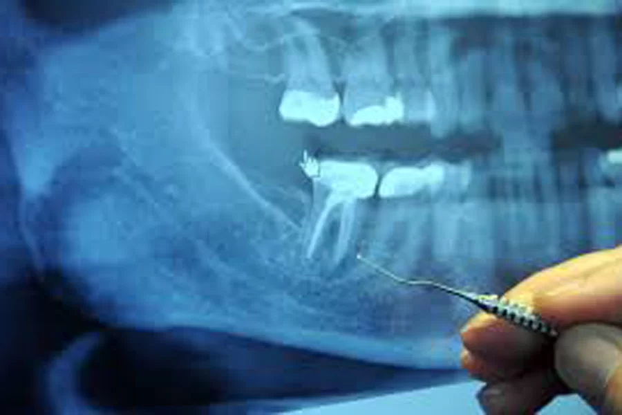 国立の歯医者、国立深澤歯科クリニックの親知らずの抜歯