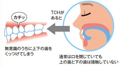 国立の歯医者、国立深澤歯科クリニックの歯列接触癖対策