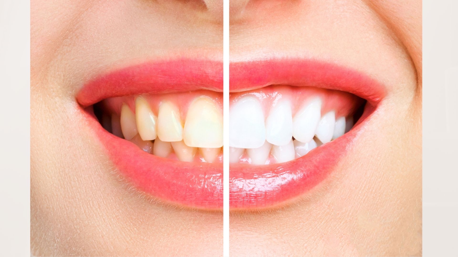 セルフホワイトニング   すぐに始められます。 歯を白くするならどっち？セルフホワイトニングと医療ホワイトニングを