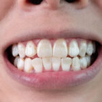 国立駅徒歩3分の歯医者、国立深澤歯科クリニックで、ホワイトスポットを解説