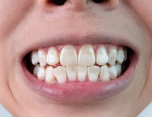 国立駅徒歩3分の歯医者、国立深澤歯科クリニックで、ホワイトスポットを解説