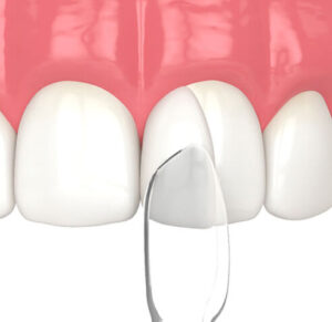 国立駅徒歩3分の歯医者、国立深澤歯科クリニックで、ホワイトスポットを解説