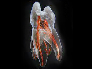 国立駅徒歩3分の歯医者、国立深澤歯科クリニックで、湾曲根管を解説