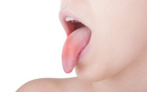 国立駅徒歩3分の歯医者、国立深澤歯科クリニックで、更年期女性に多い「口腔灼熱症候群」の症状と治療法を解説