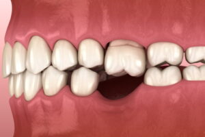 国立駅徒歩3分の歯医者、国立深澤歯科クリニックで、奥歯が1本ないだけでも大きな問題となるのはなぜ？その原因や治療の選択肢を解説