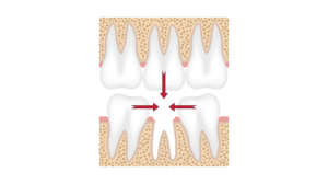 国立駅徒歩3分の歯医者、国立深澤歯科クリニックで、奥歯が1本ないだけでも大きな問題となるのはなぜ？その原因や治療の選択肢を解説