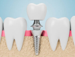 国立駅徒歩3分の歯医者、国立深澤歯科クリニックで、奥歯が1本ないだけでも大きな問題となるのはなぜ？その原因や治療の選択肢を解説